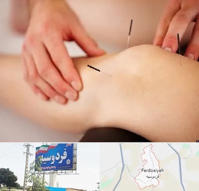 دکتر طب سوزنی برای لاغری در فردوسیه شهریار