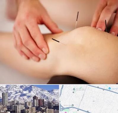 دکتر طب سوزنی برای لاغری در ازگل