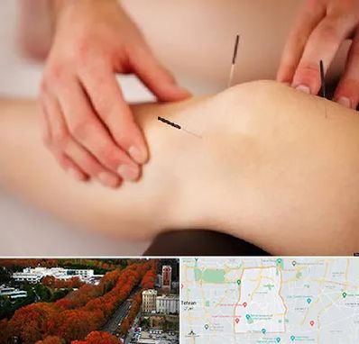 دکتر طب سوزنی برای لاغری در منطقه 6 تهران 