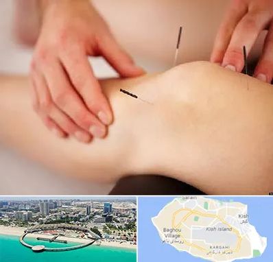 دکتر طب سوزنی برای لاغری در کیش