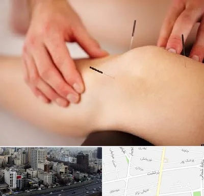 دکتر طب سوزنی برای لاغری در زرتشت