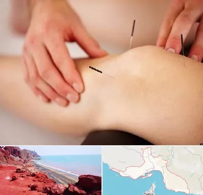 دکتر طب سوزنی برای لاغری در هرمزگان