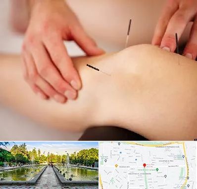 دکتر طب سوزنی برای لاغری در سرسبز 