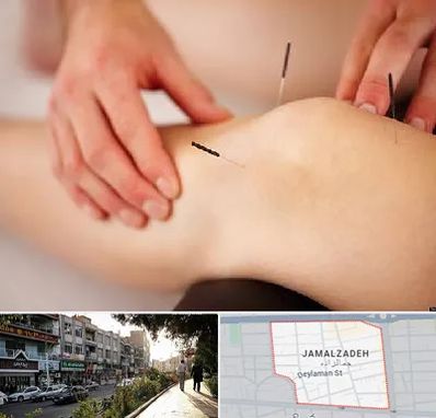 دکتر طب سوزنی برای لاغری در خیابان جمالزاده