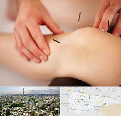 دکتر طب سوزنی برای لاغری در منطقه 8 تهران 