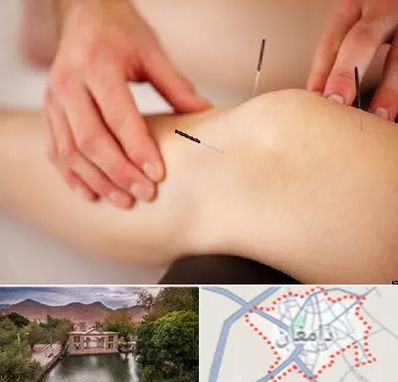 دکتر طب سوزنی برای لاغری در دامغان
