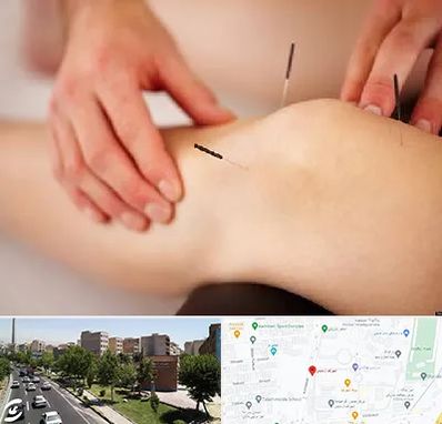 دکتر طب سوزنی برای لاغری در شهرک آزمایش 