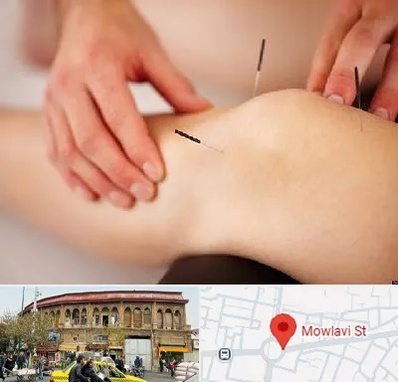 دکتر طب سوزنی برای لاغری در مولوی