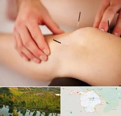 دکتر طب سوزنی برای لاغری در بهبهان