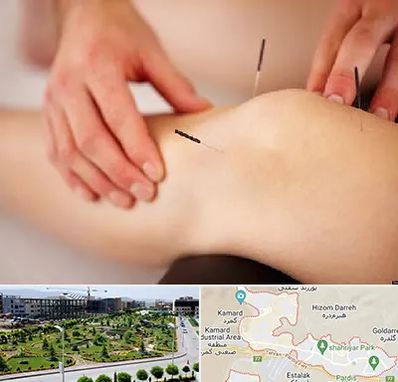 دکتر طب سوزنی برای لاغری در پردیس