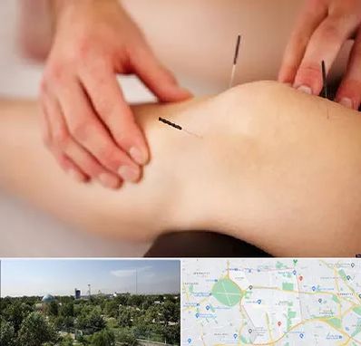 دکتر طب سوزنی برای لاغری در منطقه 16 تهران 