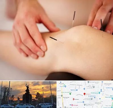 دکتر طب سوزنی برای لاغری در میدان حر 