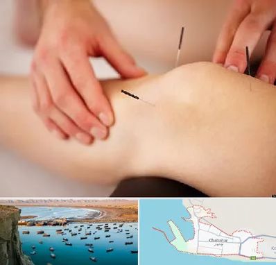 دکتر طب سوزنی برای لاغری در چابهار
