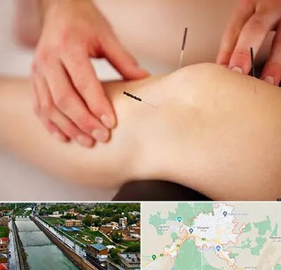 دکتر طب سوزنی برای لاغری در مراغه
