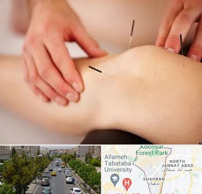 دکتر طب سوزنی برای لاغری در شهران 