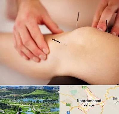دکتر طب سوزنی برای لاغری در خرم آباد