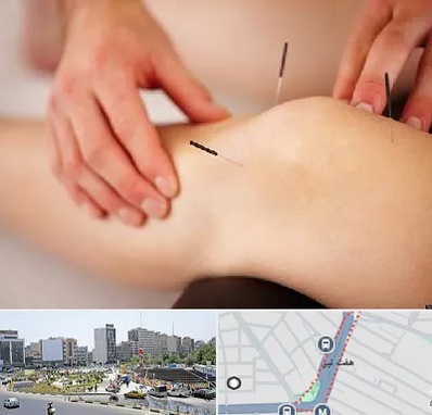 دکتر طب سوزنی برای لاغری در هفت تیر