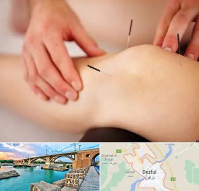 دکتر طب سوزنی برای لاغری در دزفول