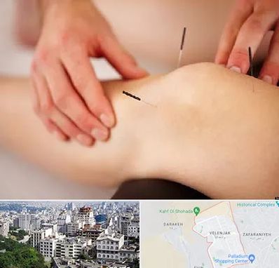 دکتر طب سوزنی برای لاغری در ولنجک 