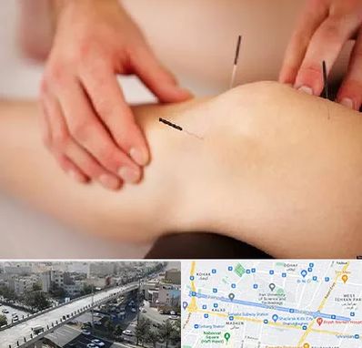 دکتر طب سوزنی برای لاغری در فرجام 