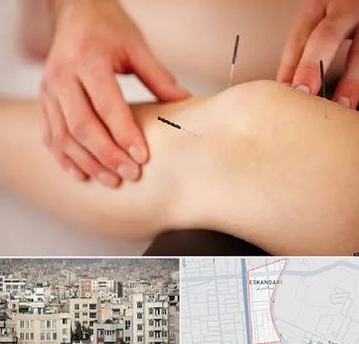 دکتر طب سوزنی برای لاغری در اسکندری