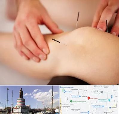 دکتر طب سوزنی برای لاغری در کارگر جنوبی 