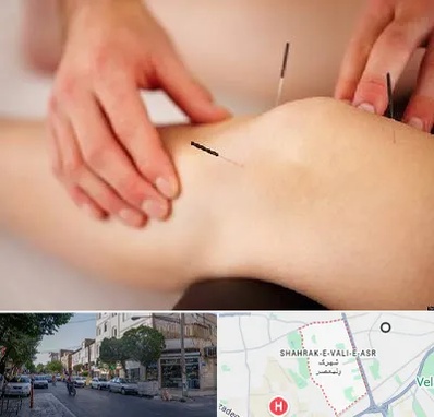 دکتر طب سوزنی برای لاغری در شهرک ولیعصر