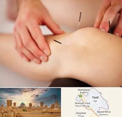 دکتر طب سوزنی برای لاغری در یزد
