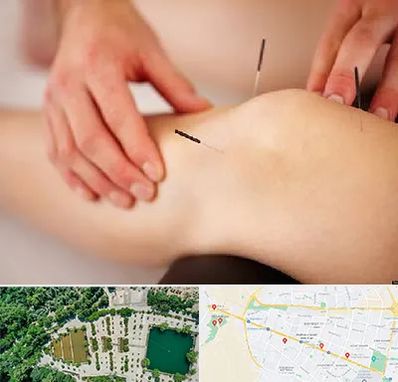 دکتر طب سوزنی برای لاغری در وکیل آباد مشهد
