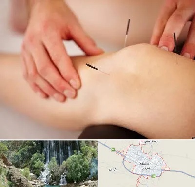 دکتر طب سوزنی برای لاغری در شیروان