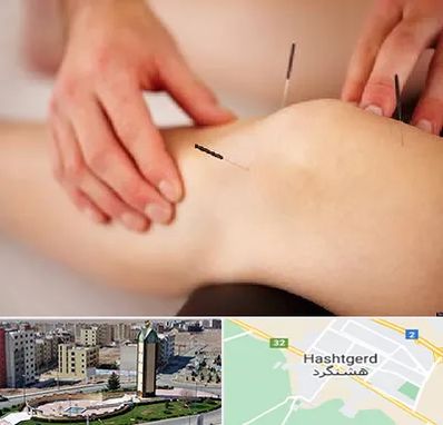 دکتر طب سوزنی برای لاغری در هشتگرد