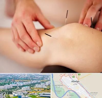 دکتر طب سوزنی برای لاغری در آبادان