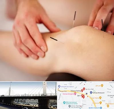 دکتر طب سوزنی برای لاغری در پارک وی 