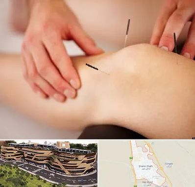 دکتر طب سوزنی برای لاغری در شاهین شهر