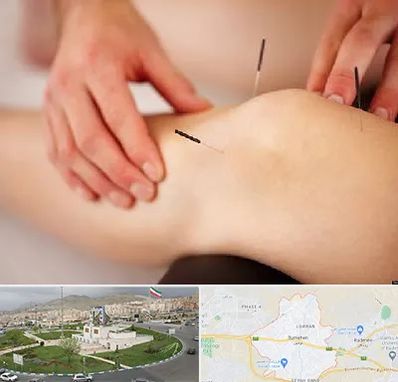 دکتر طب سوزنی برای لاغری در بومهن