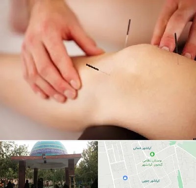 دکتر طب سوزنی برای لاغری در کیانشهر