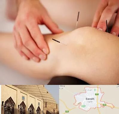 دکتر طب سوزنی برای لاغری در ساوه