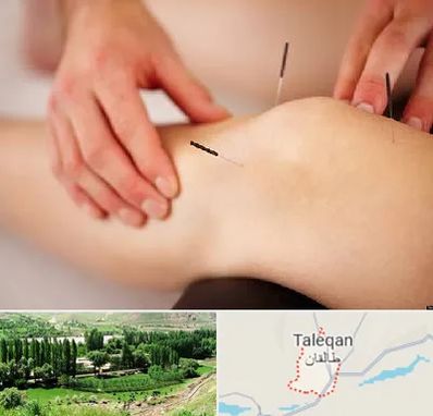 دکتر طب سوزنی برای لاغری در طالقان