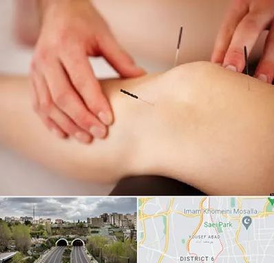 دکتر طب سوزنی برای لاغری در یوسف آباد 