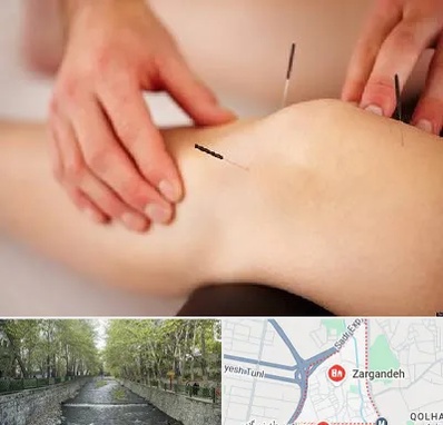 دکتر طب سوزنی برای لاغری در زرگنده