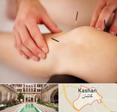 دکتر طب سوزنی برای لاغری در کاشان