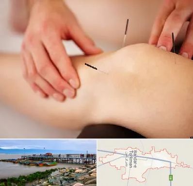 دکتر طب سوزنی برای لاغری در بندر ترکمن