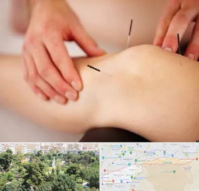 دکتر طب سوزنی برای لاغری در منطقه 13 تهران 