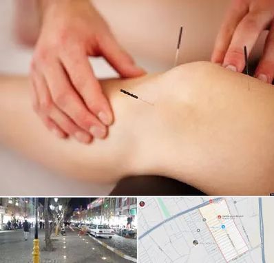 دکتر طب سوزنی برای لاغری در باغ فیض اسلامشهر 