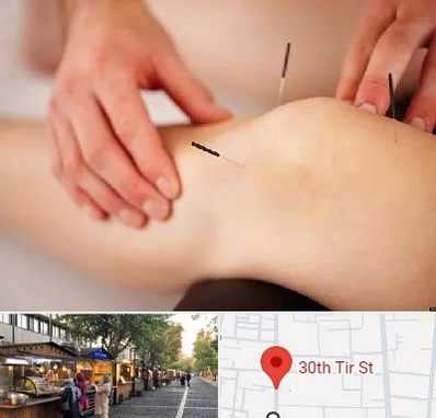 دکتر طب سوزنی برای لاغری در سی تیر