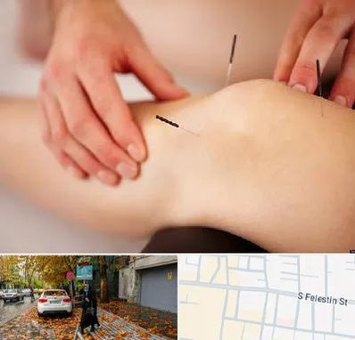 دکتر طب سوزنی برای لاغری در خیابان فلسطین