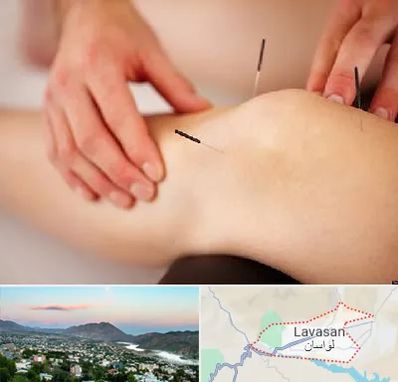 دکتر طب سوزنی برای لاغری در لواسان