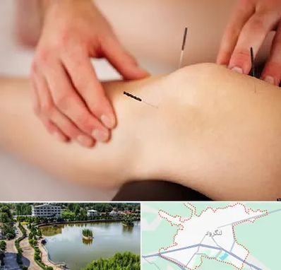 دکتر طب سوزنی برای لاغری در لنگرود