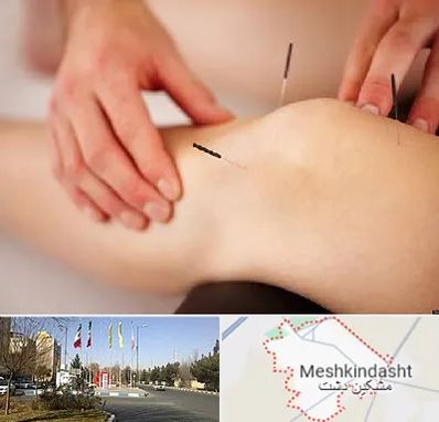 دکتر طب سوزنی برای لاغری در مشکین دشت