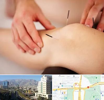 دکتر طب سوزنی برای لاغری در حقانی 